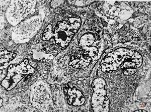 M,51y. | scrotal myosarcoma